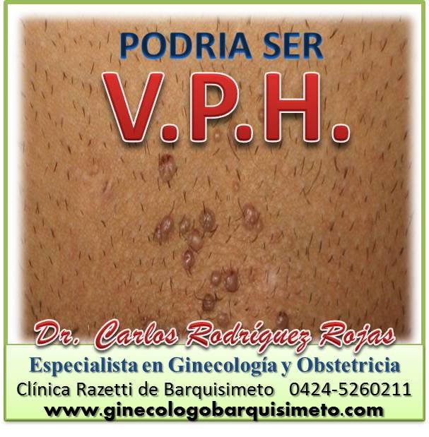 En este momento estás viendo V.P.H. ¿Conoces el  Virus del Papiloma Humano?